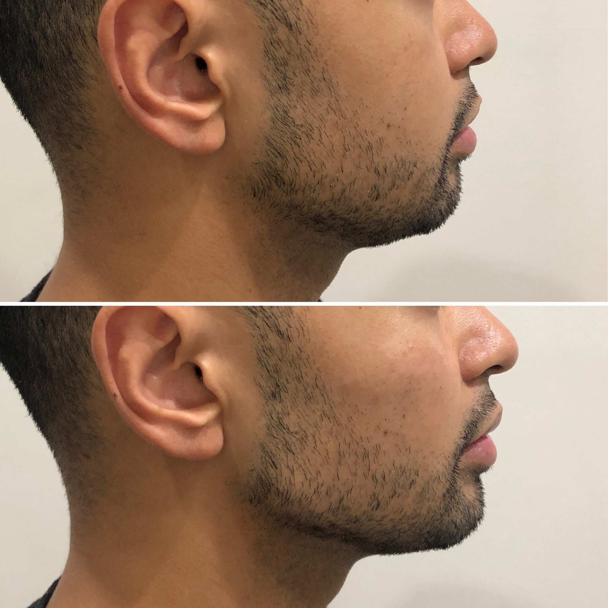 Chin-Male-1