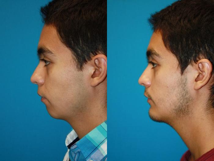 chin-aug