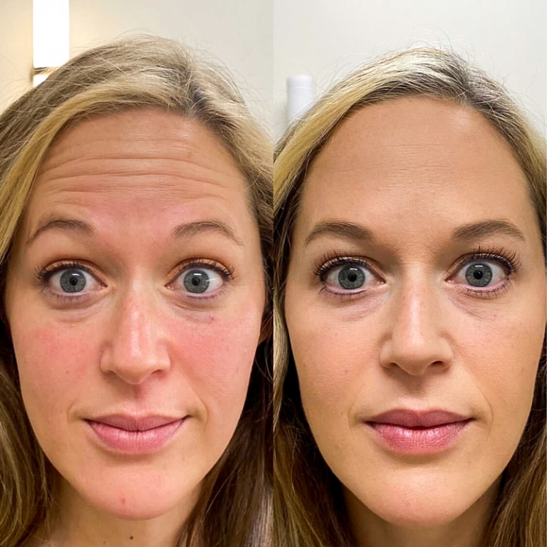 foto-1-botox