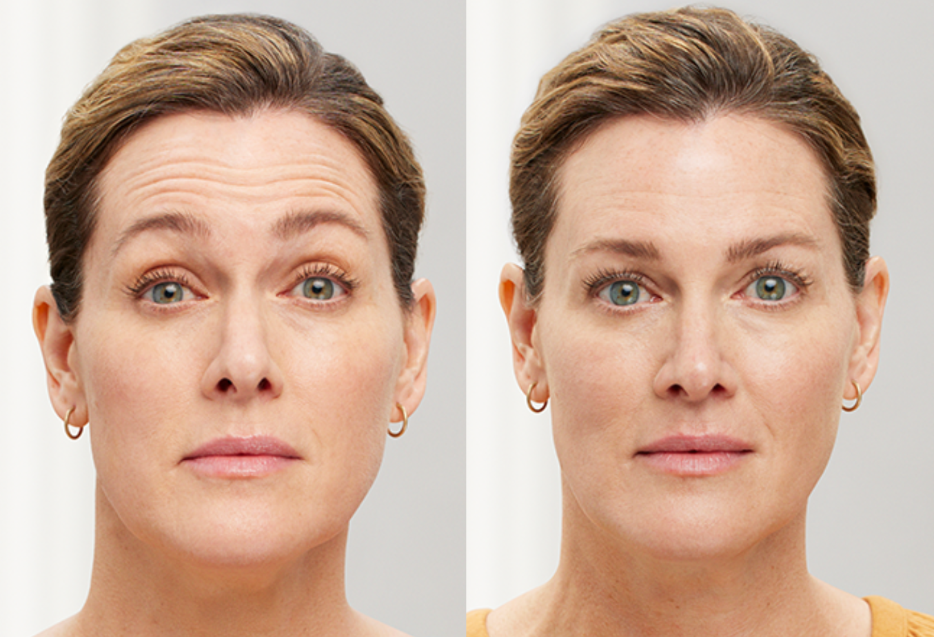 foto-4-botox