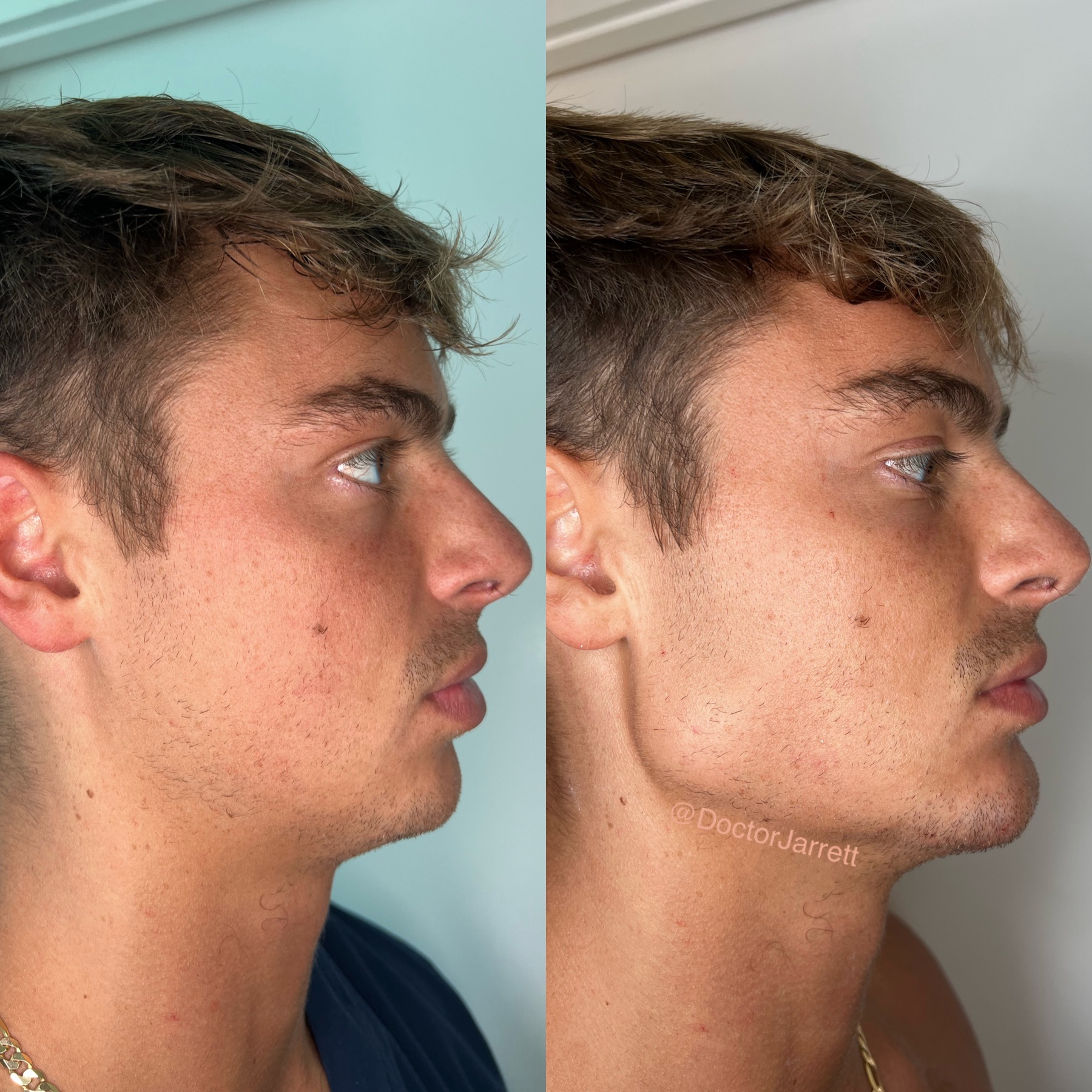 jawline-filler