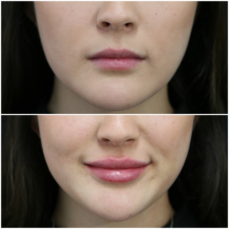 lip_augmentation